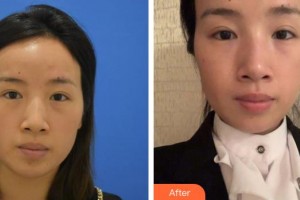 黃岡愛(ài)爾眼科醫(yī)院方敏整形價(jià)格表附激光去眼袋案例展示