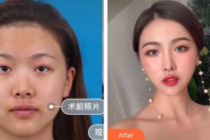 隨州真愛整形美容醫(yī)院高成整形價格表附鼻部綜合案例展示