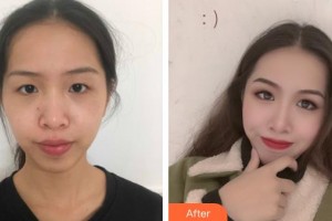 隨州愛爾眼科醫(yī)院江霞整形價格表附眼部綜合案例展示