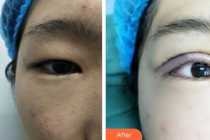 隨州愛爾眼科醫(yī)院姚大權(quán)整形價格表附切開雙眼皮案例展示