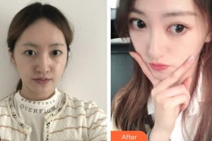 咸寧奧萊醫(yī)療美容門診部陳鷲整形價格表附熱瑪吉案例展示