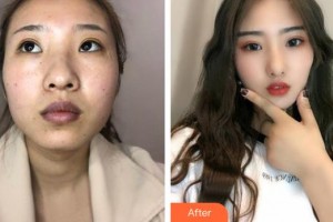 咸寧愛爾眼科醫(yī)院操盛春整形價格表附眼部綜合案例展示