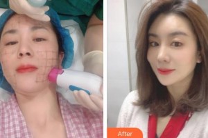 孝感仁愛醫(yī)院美容整形中心王悅整形價格表附熱瑪吉案例展示