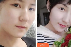 孝感華美醫(yī)療美容門診部黃露整形價(jià)格表附埋線提升案例展示