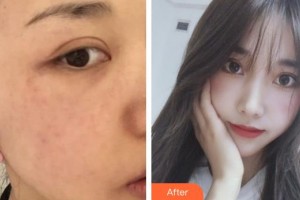 孝感仁愛(ài)醫(yī)院美容整形中心涂忠駿整形價(jià)格表附激光美膚激光案例展示