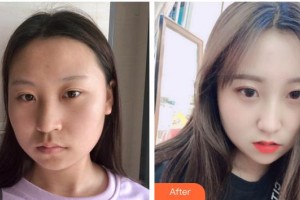 孝感歐陽整形美容診所劉琳整形價格表附埋線提升案例展示