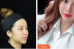 孝感天妃醫(yī)療美容門診部吳紀園整形價格表附射頻緊膚例展示