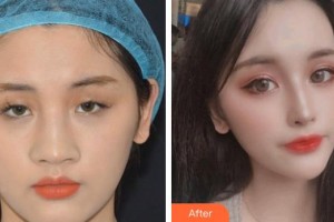 孝感愛爾眼科醫(yī)院陳劍整形價格表附眼部綜合案例展示