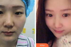 孝感愛爾眼科醫(yī)院熊煒整形價格表附眼部綜合案例展示