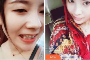 孝感愛(ài)爾眼科醫(yī)院李川輝整形價(jià)格表附切開(kāi)雙眼皮案例展示