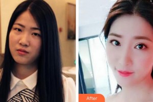 孝感愛爾眼科醫(yī)院李勇整形價格表附切開雙眼皮案例展示