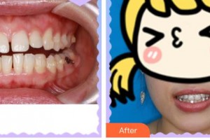 孝感植貝爾口腔門診部程瑞整形價(jià)格表附牙貼面案例展示