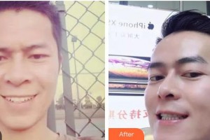 鄂州中山口腔醫(yī)院徐榮建整形價格表附金屬托槽矯正案例展示