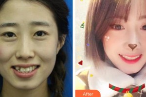 鄂州中山口腔醫(yī)院黃琪整形價格表附金屬托槽矯正案例展示