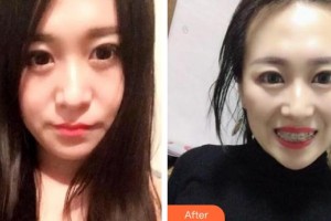 鄂州中山口腔醫(yī)院龔嵐整形價格表附金屬托槽矯正案例展示