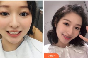 鄂州中山口腔醫(yī)院徐甜整形價格表附金屬托槽矯正案例展示