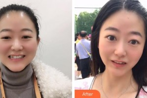 鄂州中山口腔醫(yī)院蔣松波整形價格表附牙齒隱形矯正案例展示