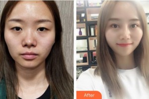 鄂州愛爾眼科醫(yī)院葉波整形價格表附切開雙眼皮案例展示