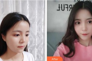 武漢兒童醫(yī)院葉嬰茀整形價(jià)格表附開(kāi)內(nèi)眼角案例展示