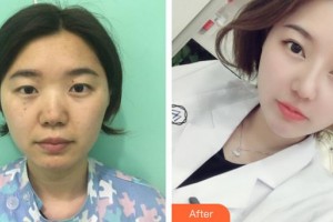 武漢兒童醫(yī)院揭紅整形價格表附眼部綜合案例展示