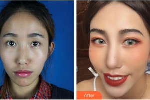 武漢艾格眼科醫(yī)院尹禾整形價格表附眼部綜合案例展示