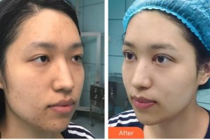 武漢艾格眼科醫(yī)院金小琴整形價(jià)格表附開(kāi)內(nèi)眼角案例展示