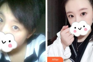 武漢艾格眼科醫(yī)院朱炎華整形價(jià)格表附眼部綜合案例展示