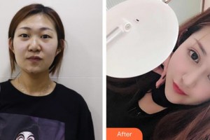 武漢艾格眼科醫(yī)院董艷霞整形價(jià)格表附切開(kāi)雙眼皮案例展示