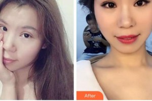 武漢艾格眼科醫(yī)院熊士波整形價(jià)格表附切開(kāi)雙眼皮案例展示