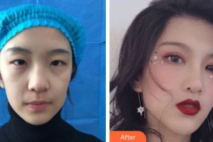 武漢艾格眼科醫(yī)院金中秋整形價格表附切開雙眼皮案例展示