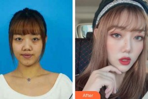 武漢艾格眼科醫(yī)院林玲整形價(jià)格表附內(nèi)切祛眼袋案例展示