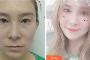 武漢艾格眼科醫(yī)院徐漢文整形價(jià)格表附眼部綜合案例展示