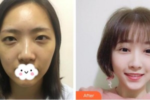 武漢艾格眼科醫(yī)院胡曉兵整形價(jià)格表附切開雙眼皮案例展示