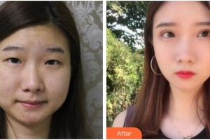 武漢艾格眼科醫(yī)院張?jiān)接⒄蝺r(jià)格表附切開雙眼皮案例展示