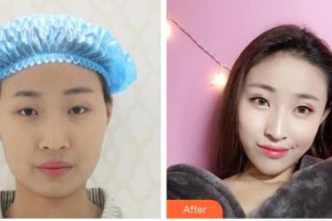 武漢佰視達(dá)眼科門診部鄭兩定整形價(jià)格表附切開雙眼皮案例展示