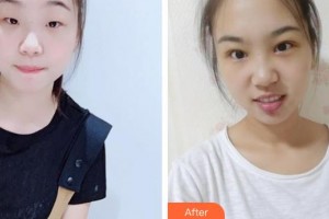 武漢佰視達(dá)眼科門診部顧兢兢整形價(jià)格表附切開雙眼皮案例展示