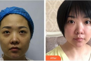 黃石市第五醫(yī)院整形外科黃曉明整形價(jià)格表附埋線提升案例展示