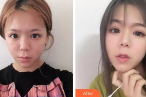 黃石市中心醫(yī)院整形外科萬(wàn)文勇整形價(jià)格表附熱拉提案例展示