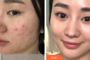 黃石華中?？滇t(yī)院（華中.華美）張智珍整形價(jià)格表附黃金微針案例展示