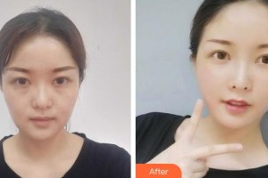 黃石華中?？滇t(yī)院（華中.華美）曹英武整形價(jià)格表附埋線提升案例展示