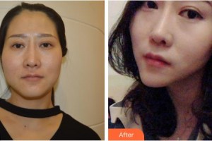 黃石市中心醫(yī)院整形外科金志福整形價(jià)格表附埋線提升案例展示