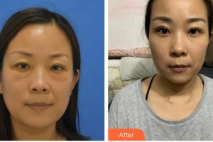 黃石愛爾眼科醫(yī)院曹剛琴整形價(jià)格表附切開雙眼皮案例展示