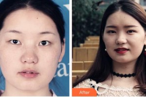 黃石愛爾眼科醫(yī)院汪建整形價(jià)格表附切開雙眼皮案例展示