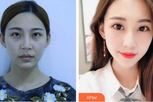 黃石愛爾眼科醫(yī)院陳洋整形價格表附內切祛眼袋案例展示