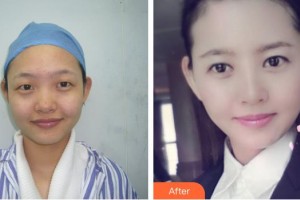 黃石愛爾眼科醫(yī)院程國旺整形價(jià)格表附眼部綜合案例展示