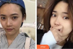 黃石愛爾眼科醫(yī)院朱劍整形價格表附內切祛眼袋案例展示