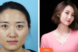 黃石愛爾眼科醫(yī)院吳湘整形價格表附切開雙眼皮案例展示