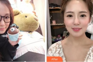 黃石中山口腔醫(yī)院曹先利整形價格表附金屬托槽矯正案例展示