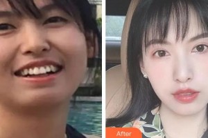 黃石現(xiàn)代口腔醫(yī)院李蒙整形價格表附金屬托槽矯正案例展示