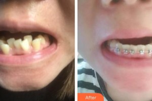 黃石春天口腔門診部陳炳軍整形價格表附金屬托槽矯正案例展示